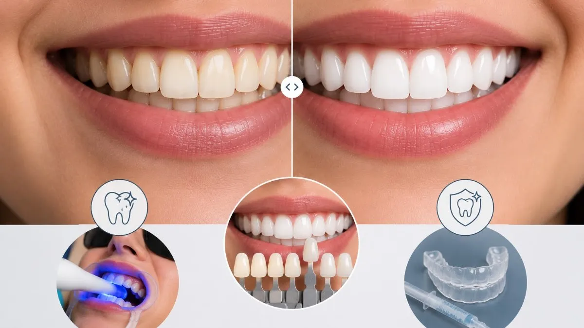Blanqueamiento Dental: Métodos Seguros y Efectivos