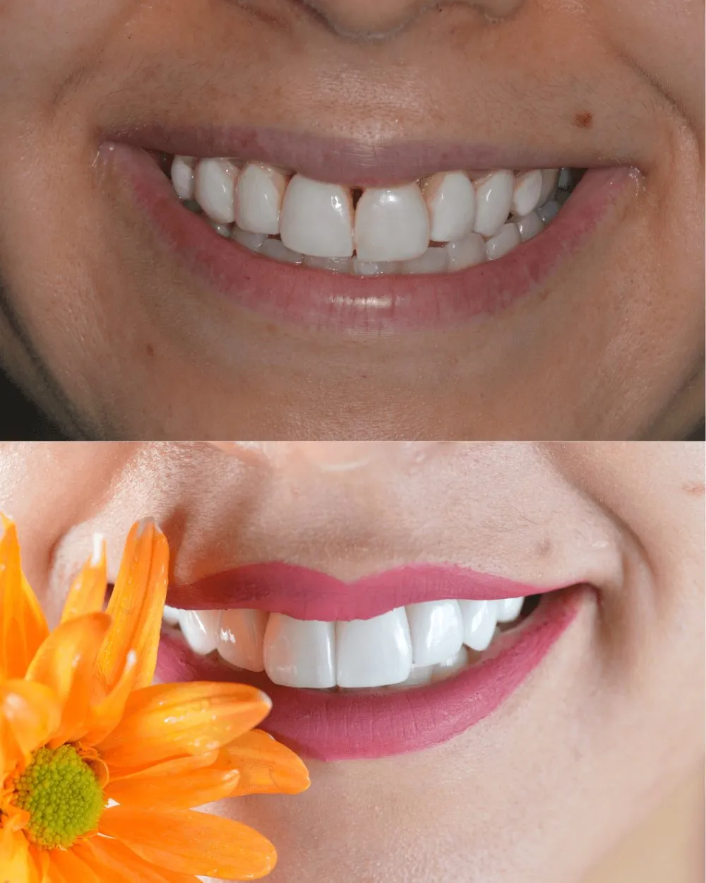 Antes y después diseño de sonrisa — Luxe-Smile