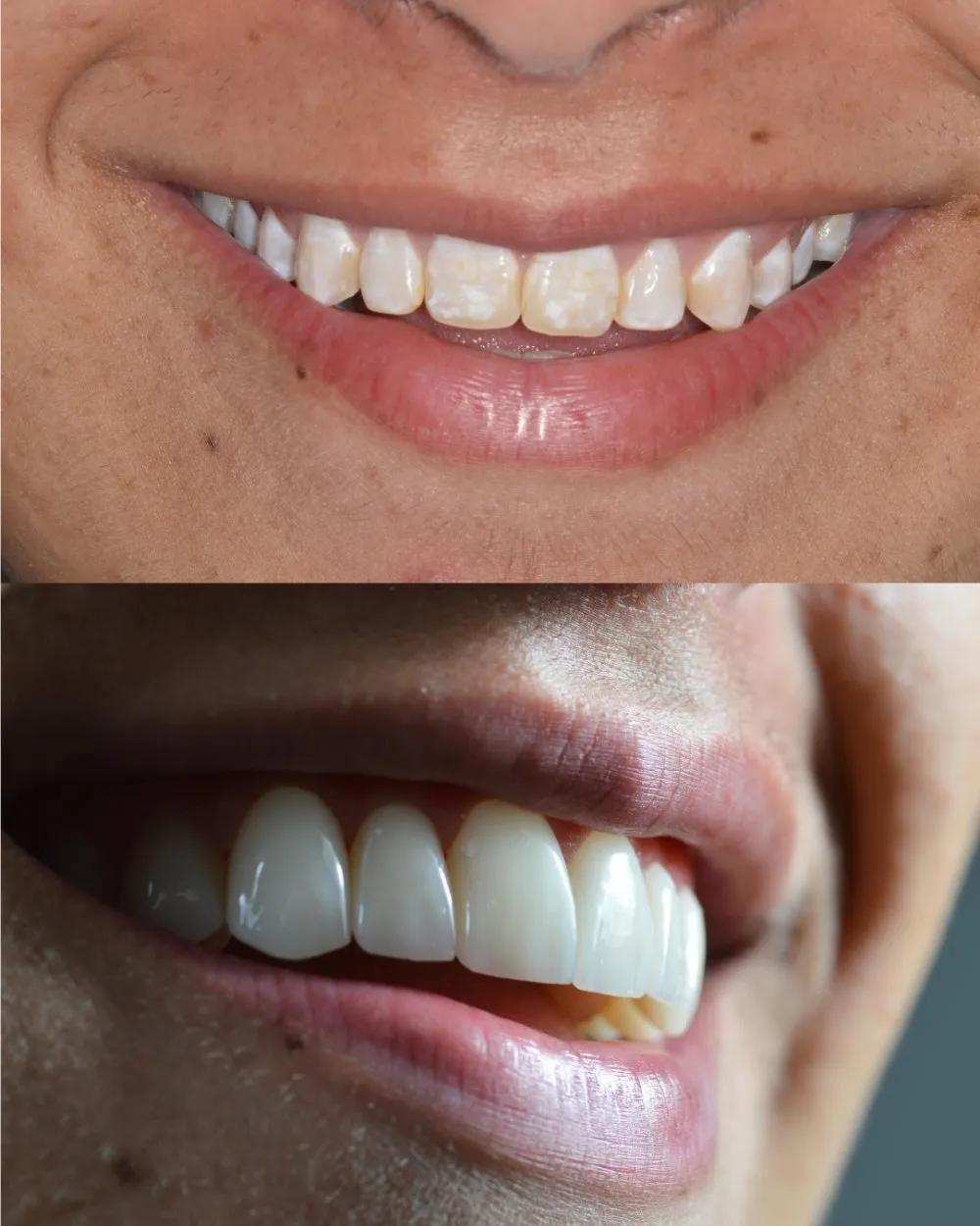 Resultado carillas de porcelana — Luxe-Smile