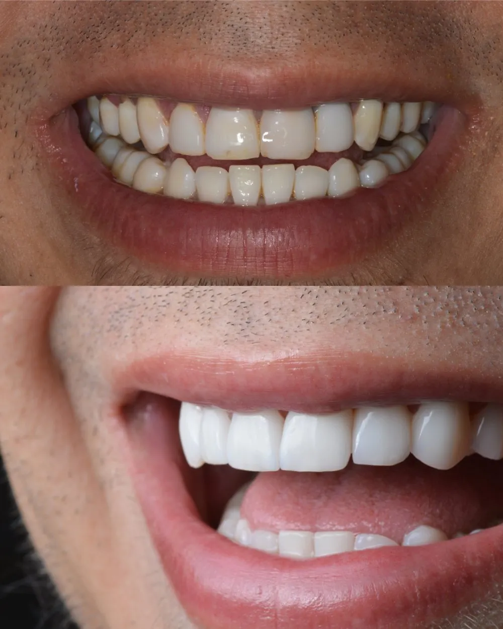 Caso real diseño de sonrisa Bogotá — Luxe-Smile