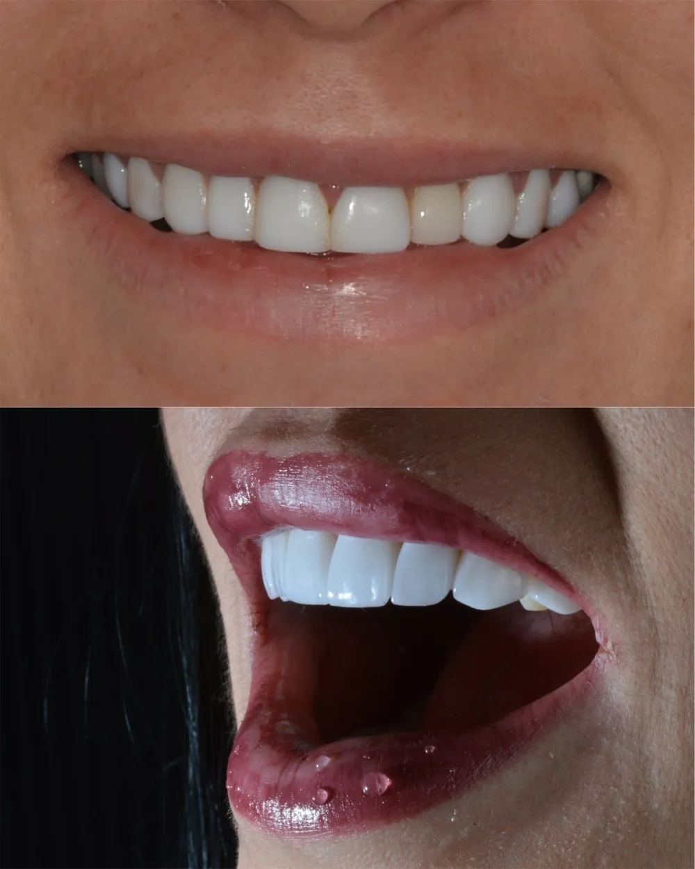 Transformación dental antes y después — Luxe-Smile