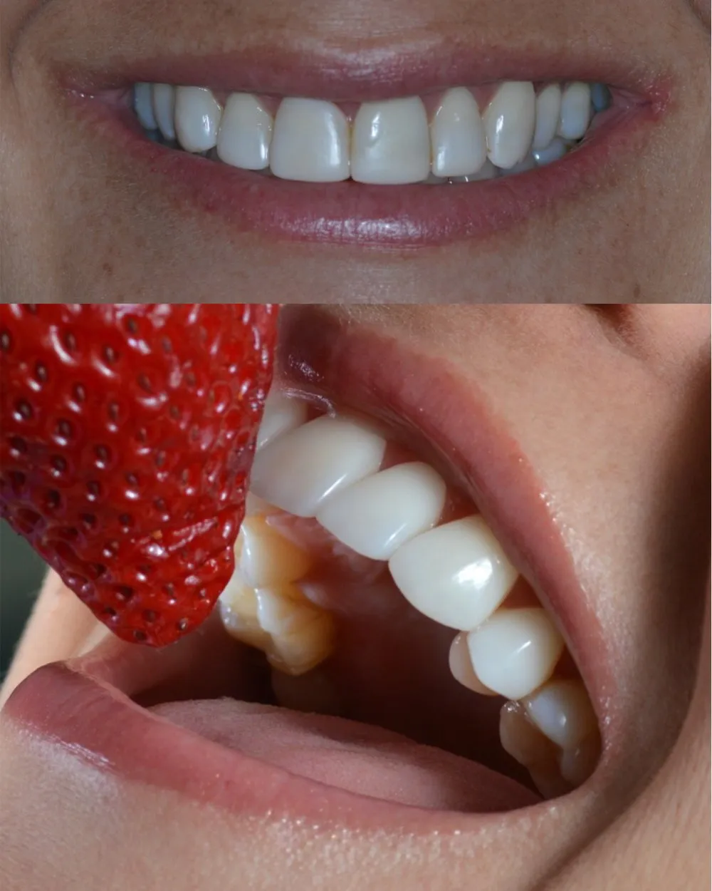 Diseño de sonrisa natural Bogotá — Luxe-Smile
