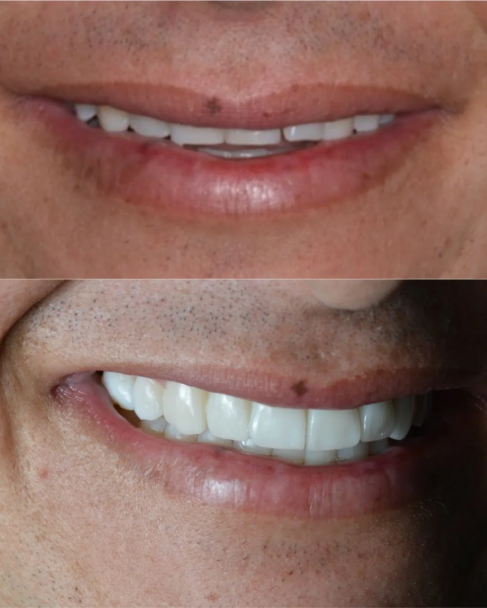 Carillas cerámicas resultado real — Luxe-Smile