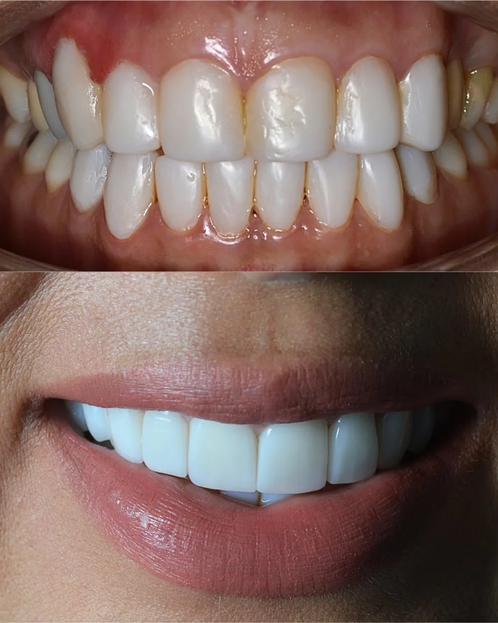 Rehabilitación oral estética Bogotá — Luxe-Smile