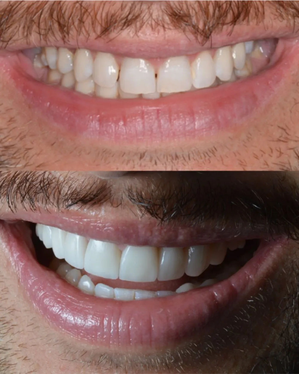 Caso clínico diseño de sonrisa — Luxe-Smile